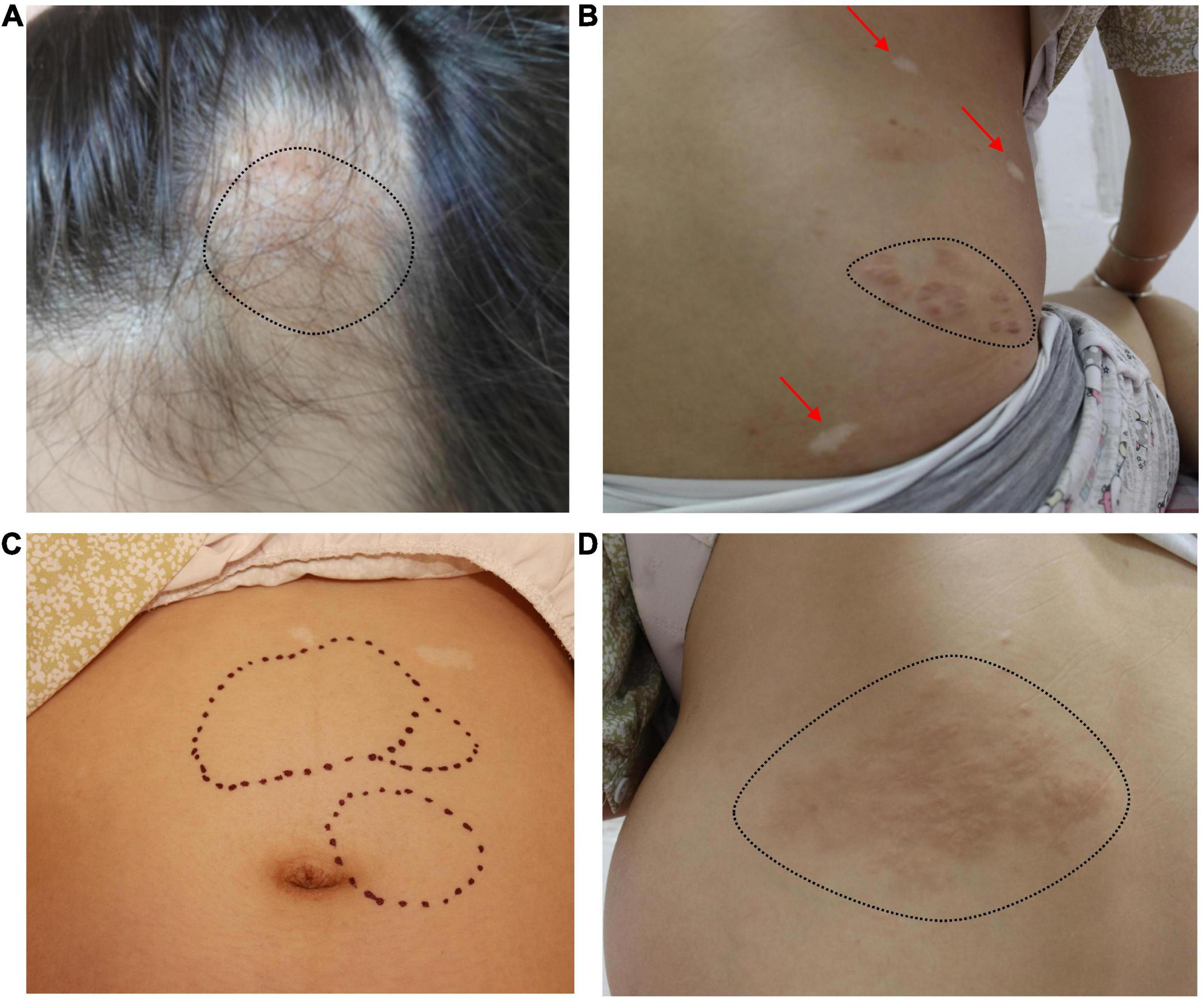 TSC2/PKD1 contiguous deletion syndrome in a pregnant woman: A case report